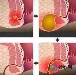 肛管炎,肛管炎有什么症状