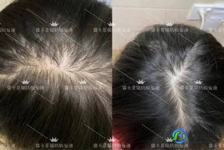 何首乌提取物,何首乌提取物对头发的作用有什么