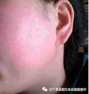 脸颊两侧发红,为什么脸颊两边总是红红的怎么办