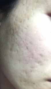 脸上长痘坑,脸上很多痘坑怎么处理