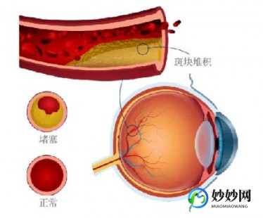 静脉闭塞,静脉堵塞是什么症状