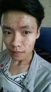 长痘怎么办,身上长痘痘怎么治疗