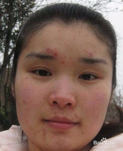 长痘怎么办,身上长痘痘怎么治疗