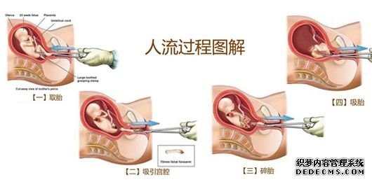 的人流,做人流是什么意思