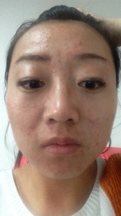 脸上反复长痘痘,最近几个月脸上总是反复长痘