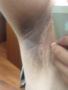 青少年腋下有味怎么除,未成年有狐臭怎么办