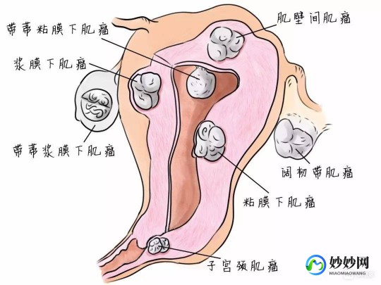 有子宫肌瘤怎么办,有子宫肌瘤怎么办
