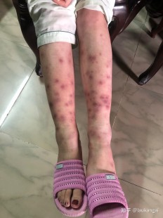 结节性红斑,结节性红斑多久能消退