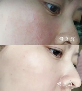 脸蛋有红血丝怎么办,脸颊发红有红血丝怎么办