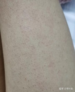 鸡皮肤特效药,腿上鸡皮肤怎么治
