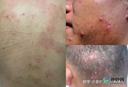 鬼头上长了小红粒粒,男生上有红色颗粒