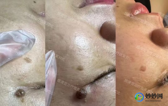 点痦子,痦子怎么去掉