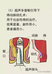 痔疮病因病理,痔疮的成因及原理是什么