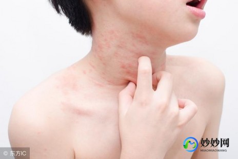 过敏性药疹的治疗,药物过敏起红疹痒怎么缓解