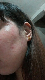 脸上过敏发红痒肿还有小疙瘩怎么解决,脸部过敏发红长痘痘痒怎么办