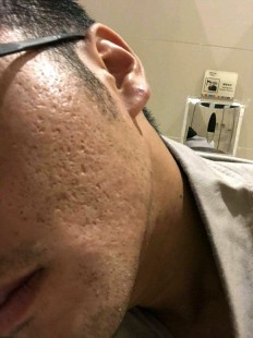 治疗痘坑,脸上很多痘坑怎么处理