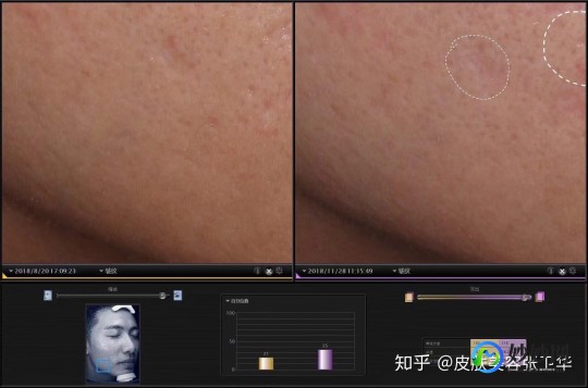 治疗痘坑,脸上很多痘坑怎么处理