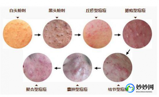 青春期痤疮,青春期脸上长痘痘