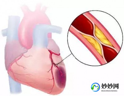 血栓是什么,血栓是什么意思