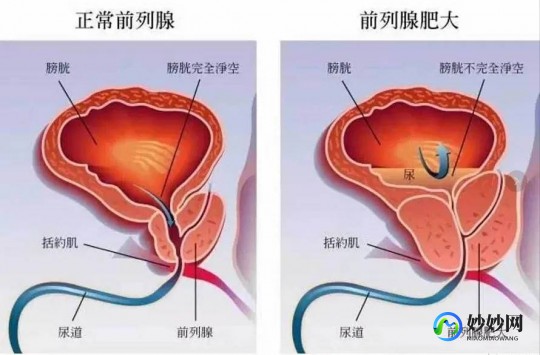 治疗前列腺肥大,怎么治疗前列腺肥大