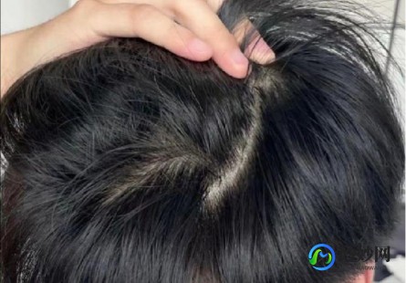 头痒,头一直痒怎么办
