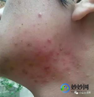 附近长了个疙瘩,周围有小疙瘩是怎么回事