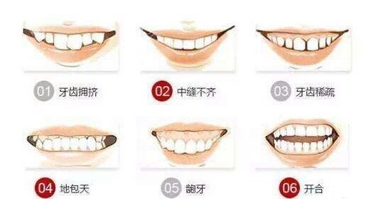 牙齿矫正正畸,牙齿正畸的方法有哪些