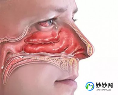 过敏性鼻窦炎,过敏性鼻窦炎是什么