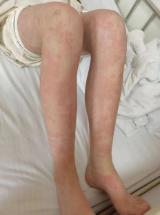 身上起了红色的疙瘩还鼓起了包,身上起疙瘩还肿了怎么回事