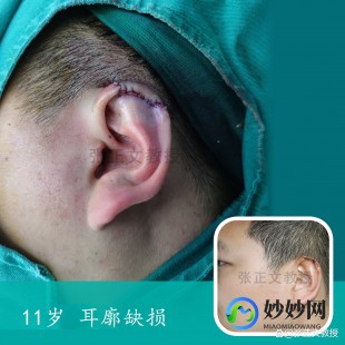 耳朵能再造吗,耳朵能再造吗