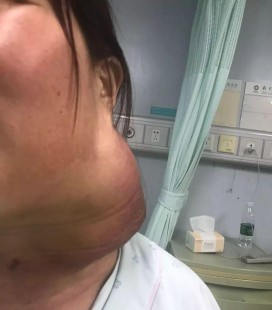 颈部淋巴结肿大脖子痛,颈部淋巴结肿大疼痛