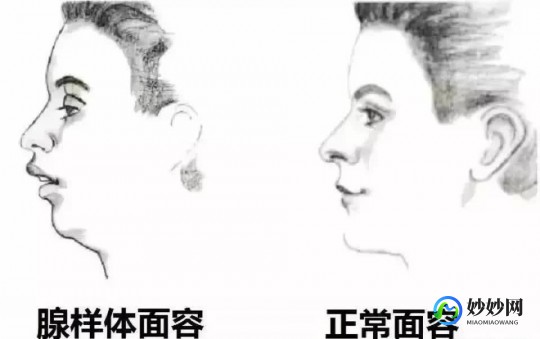 腺样体肥大,腺样体肥大是什么意思