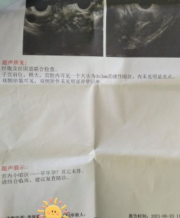 停经35天,月经35天没来