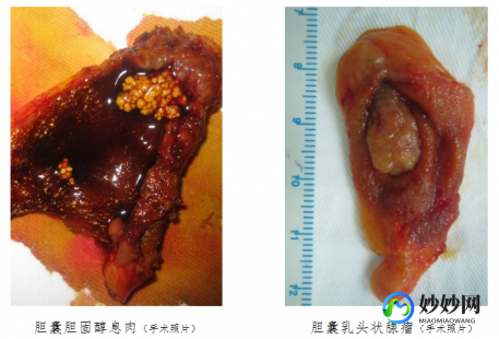 胆囊息肉手术,胆囊息肉怎么切除
