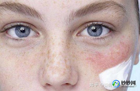 脸部过敏,脸过敏泛红