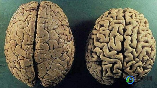 干缩人头,脑萎缩是怎么引起的