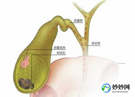 胆囊息肉怎么回事 什么原因引起的,为什么会有胆囊息肉