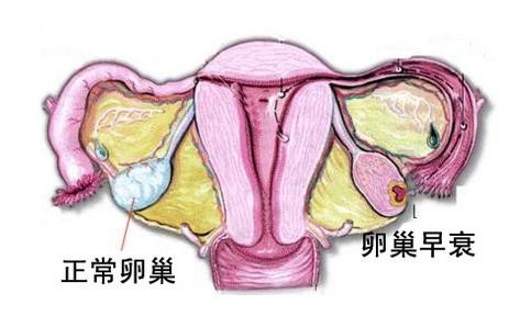 卵巢早衰内异症试管杭州(广州试管卵巢早衰)