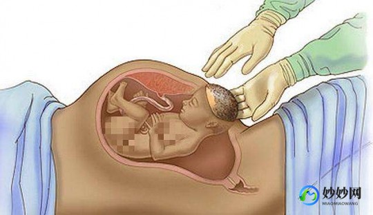 剖腹产多年不孕—剖腹产后多年不孕