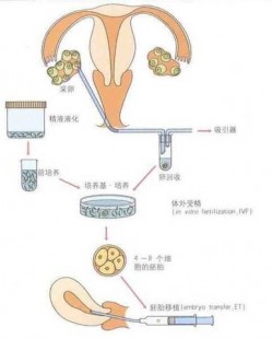 弱精症做人授还是试管好、弱精症做人工授精好还是试管好