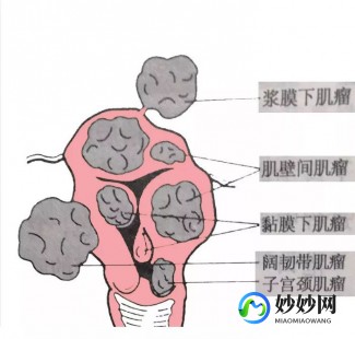 多大才不发育子宫肌瘤了多大年龄子宫肌瘤就不用做了