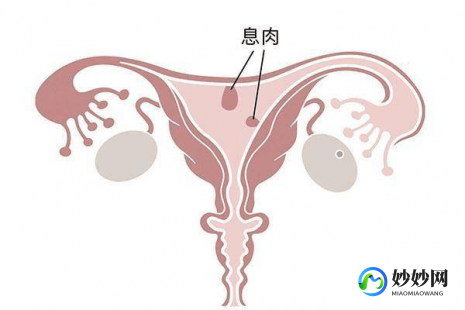 没怀孕子宫切除-没怀孕切除子宫息肉后容易复发吗