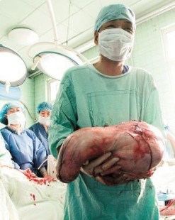 子宫切除点会怀孕吗;子宫切除还会怀孕吗