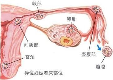 切除子宫8个月后怀孕—子宫肌瘤切除术后的8个月怀孕了
