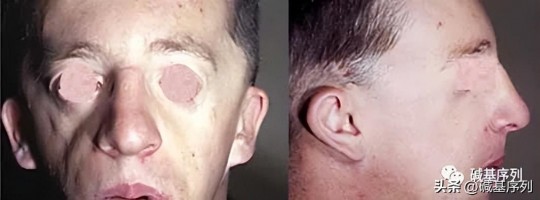 xyy染色体异常下一代影响(男性染色体xyy会影响下一代吗)