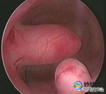 子宫息肉切除后怀孕几率、子宫息肉切除后怀孕几率大不大