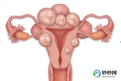 子宫息肉切除后怀孕几率、子宫息肉切除后怀孕几率大不大