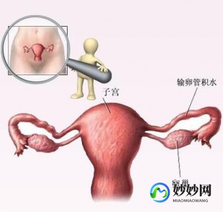 试管不成功宫腔粘连—试管不成功是不是宫腔环境不好