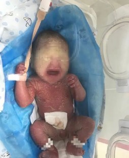 火胶棉婴,火棉胶婴儿是什么情况