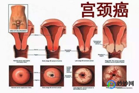 生殖疱疹终于有特效药了,专治生殖疱疹的特效药有哪些